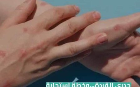 خطة وزارة الصحة للسيطرة على تفشي مرض جدري القرود